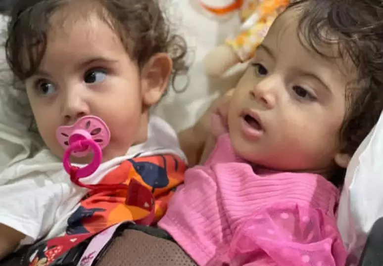 Separação das gêmeas siamesas Kiraz e Aruna foi concluída